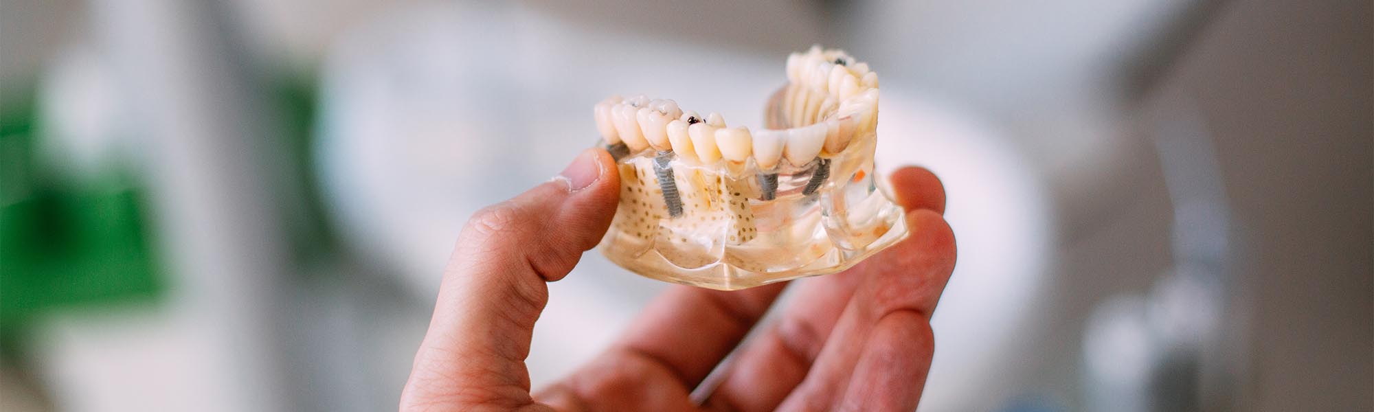 Dental Implants in Long Beach CA