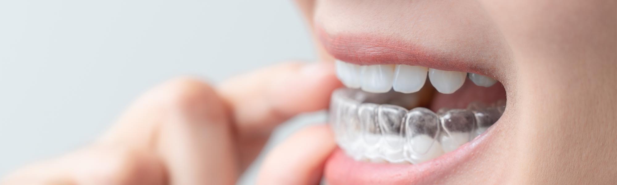 Invisalign® Benefits Long Beach CA
